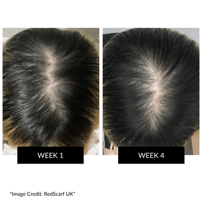 CurrentBody Skin LED 頭皮・頭髪ケアデバイス 特別価格