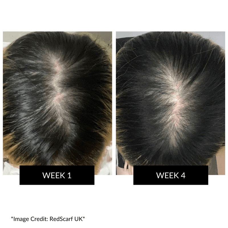 CurrentBody Skin LED 頭皮・頭髪ケアデバイス 特別価格