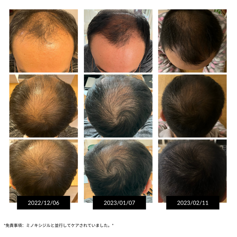 CurrentBody Skin LED 頭皮・頭髪ケアデバイス 特別価格