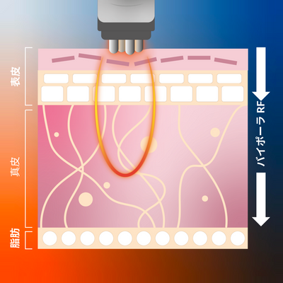 CurrentBody Skin RF ラジオ波 美顔器 特別価格