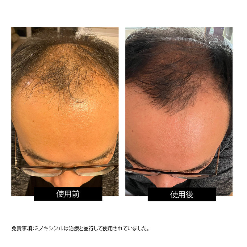 CurrentBody Skin LED 頭皮・頭髪ケアデバイス 特別価格