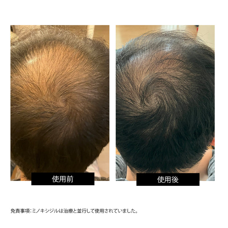 CurrentBody Skin LED 頭皮・頭髪ケアデバイス 特別価格