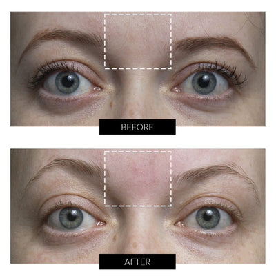 CurrentBody Skin RF ラジオ波 美顔器 特別価格