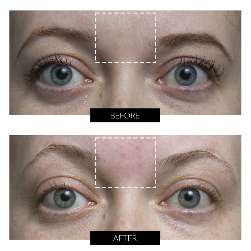 CurrentBody Skin RF ラジオ波 美顔器 特別価格