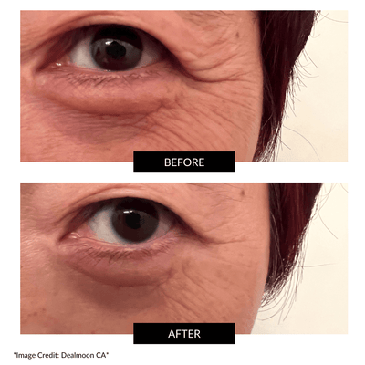 CurrentBody Skin RF ラジオ波 美顔器 特別価格