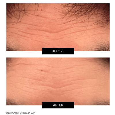 CurrentBody Skin RF ラジオ波 美顔器 特別価格