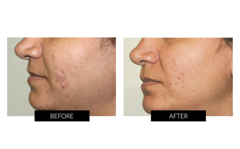 ほうれい線のシワ、ニキビ跡改善